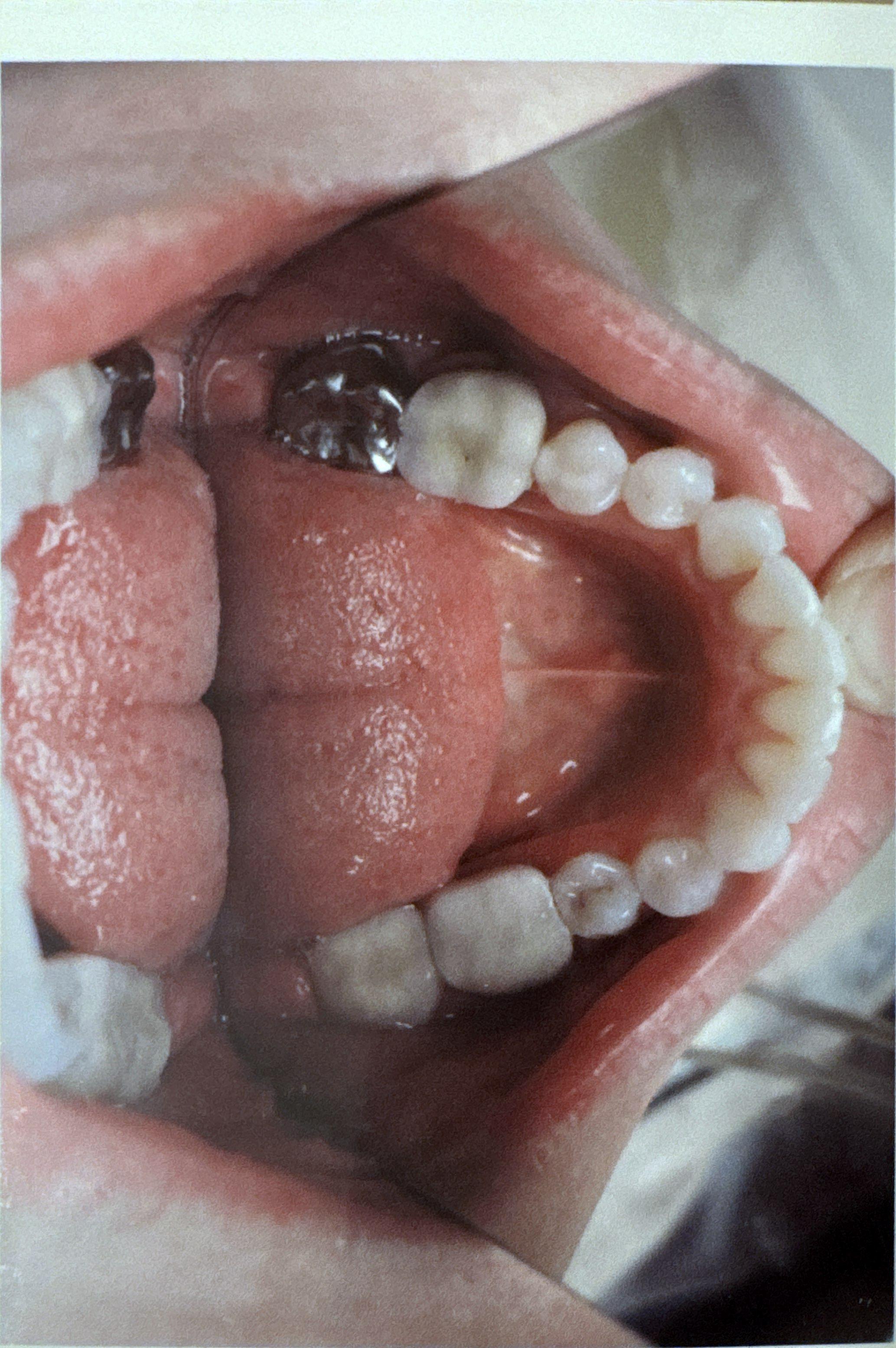 Patient teeth after Invisalign